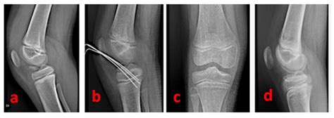 Healthcare Free Full Text Technical Note Tibial Spine Avulsion