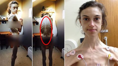 An Anorexic Woman Shares How Instagram Saved Her Life Youtube