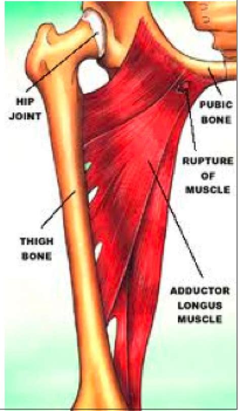 Quadricep muscles your quadricep muscles, also known as quads, consist of four muscles that compose the front of your leg; Groin Pain in Front Of | can spondylolisthesis cause groin ...