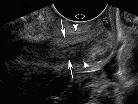Us Of The Nongravid Cervix With Multimodality Imaging Correlation Normal Appearance Pathologic