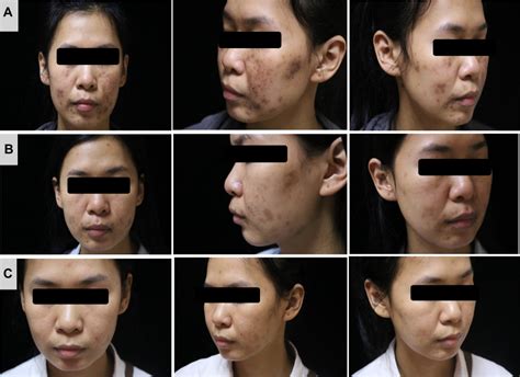 Treatment Of Minocycline Induced Facial Hyperpigmentation Ccid