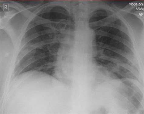 Chest X Ray Of Patient On Day 2 Postadmission Courtesy Of East Suffolk