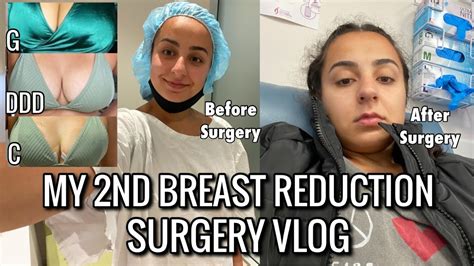 My Nd Breast Reduction Surgery Vlog Youtube