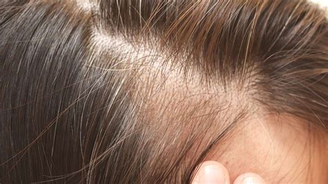 And it may not be appropriate for women who have diffuse thinning across the whole scalp. 4 Supplements You Should Take For Hair Loss, According To ...
