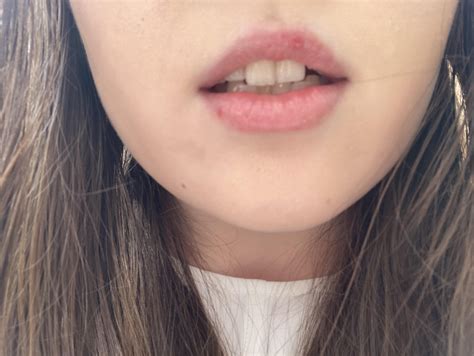 Skin Concern Worried About Red Spots On Lips Skincareaddiction