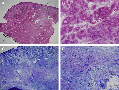 Mohs Micrographic Surgery In The Treatment Of Microcystic Adnexal