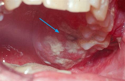 Oral Cavity Cancer Causes Symptoms Diagnosis Treatment And Prognosis