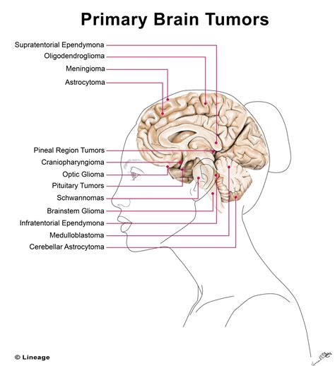 Brain Tumor Size Chart A Visual Reference Of Charts Chart Master