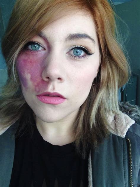 Woman Told She Was Undateable Shows Off Large Birthmark She Hid For