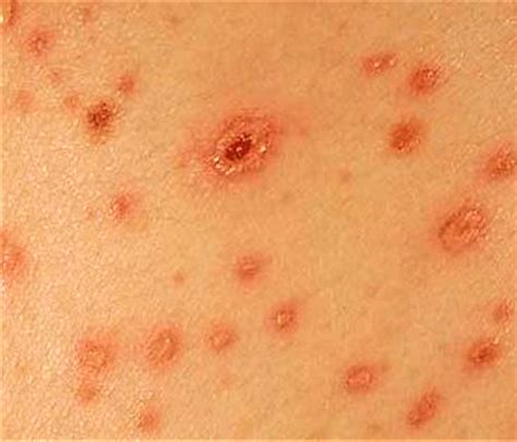 We did not find results for: Chigger bites prevention, what chigger bites look like ...