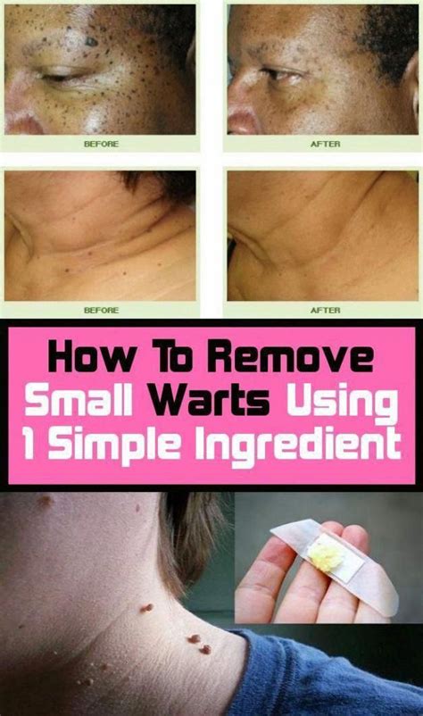 How To Remove Warts Using 1 Simple Ingredient Howtoremovewartsonface