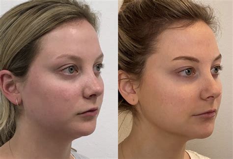 HydraFacial MD Before & After Photos | Jane Olson, MD