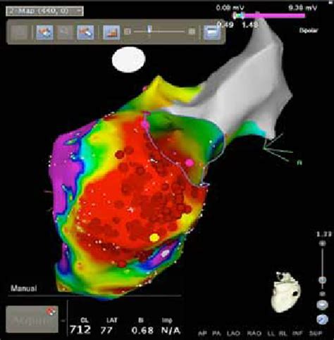 Carto Heart Mapping System