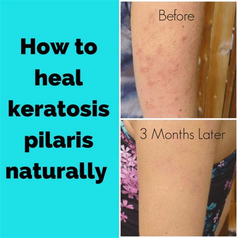 Treatment For Keratosis Pilaris Keratosis Pilaris Dry Skin Bumps Chicken Skin Remedy