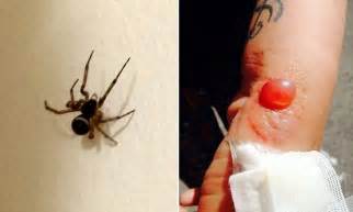 Pictured Horror Bite Of False Widow Spider Leaves Pub Landlady With Grotesquely Swollen Sore On