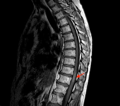 Cureus Primary Intramedullary Spinal Melanoma A Rare Disease Of The