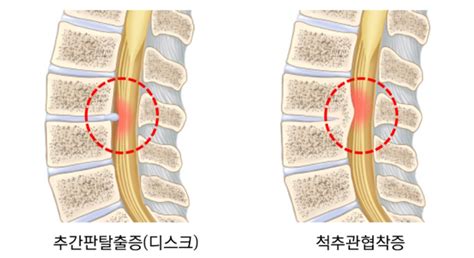 신강한의원 척추·관절·통증 몸을 앞으로 숙여야 편해지는 척추관협착증허리협착증