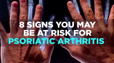 Is It Possible To Have Psoriatic Arthritis Without Psoriasis Health
