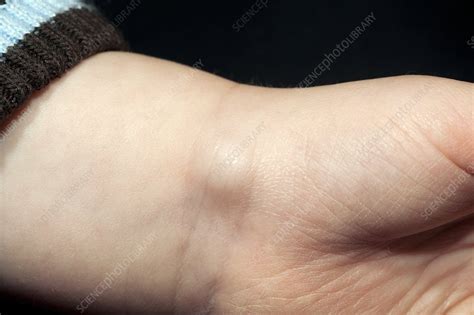 Ganglion On The Wrist Of A Child Stock Image C0117436 Science