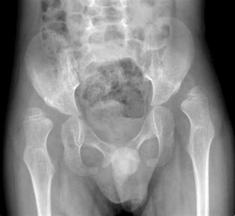 Anteroposterior Pelvis X Ray Of Patient In Preoperative Period