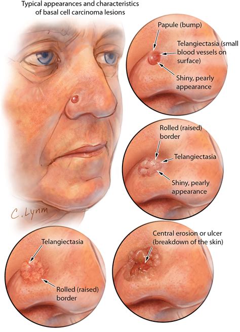 It begins in the squamous skin cells located in the top layer of skin called the epidermis.the dna in squamous cells can become damaged from ultraviolet (uv) rays from the sun or. Basal Cell Carcinoma | Dermatology | JAMA Dermatology ...