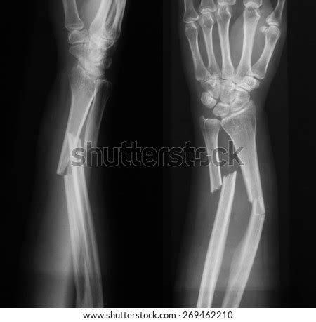 The radius, also known as the radial bone, is one of the two forearm bones in the human body, with the other one being the ulna. X-Ray Image Of Broken Forearm, Ap And Lateral View, Show ...