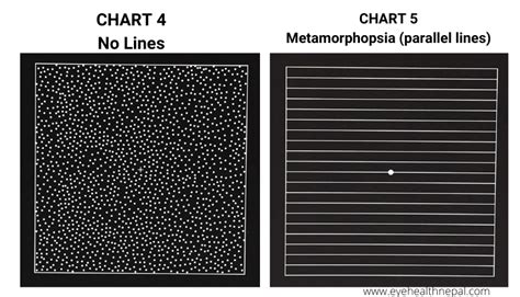 Amsler Grid Test Chart For Macular Disease Eye Health Nepal