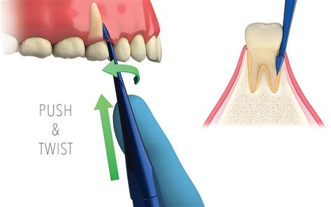 Atraumatic Extraction To Preserve The Alveolar Socket Tbs Dental