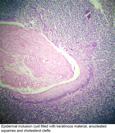 Pathology Outlines Dermoid Epidermoid Cyst