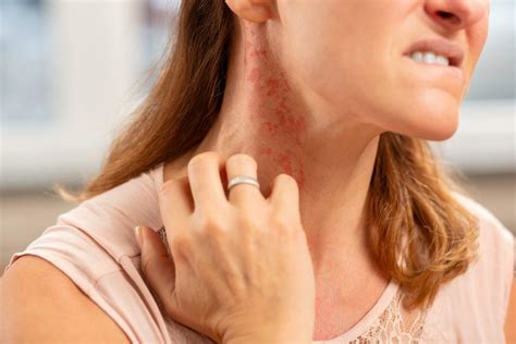 Allergic Reactions And Skin Rash Aesthetic And Dermatology Center