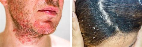 Seborrheic Dermatitis Scalp Hair Loss