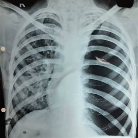 Chest X Ray Showing Tension Pneumothorax On Left Side Download