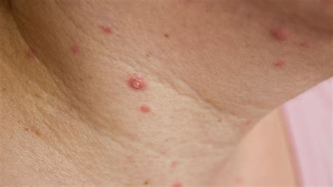 Adult Chicken Pox Symptoms And Treatment For The Virus Huffpost Uk Life