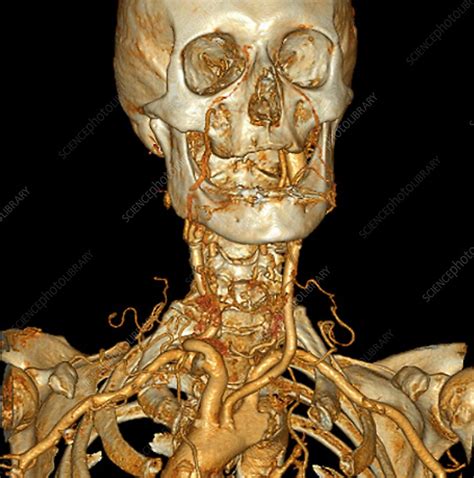 Neck And Head Arteries 3d Angio Ct Scan Stock Image C0096792
