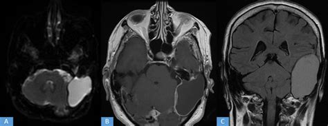Unusual Location Of A Recurrent Epidermoid Cyst
