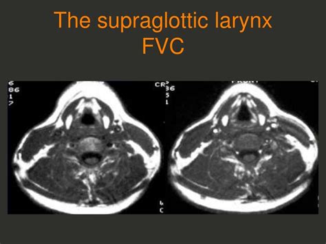 Full Story Larynx Imaging Ct Mri Dr Ahmed Esawy