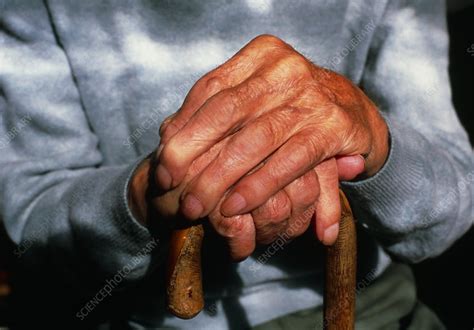 Arthritic Hands Stock Image M1100441 Science Photo Library