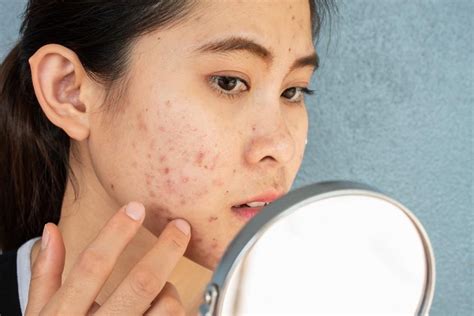 5 Reasons Why You Shouldnt Pick At Your Acne Specialists In Dermatology