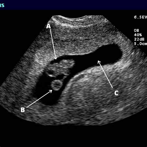 Pregnancy Essentials Part 2 Your First Ultrasound And Sonogram