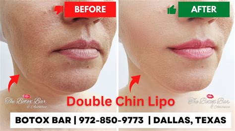 Double Chin Laser Lipo Dallas Texas Double Chin Laser Lipo Dallas