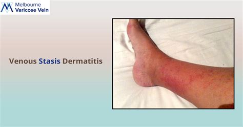Venous Stasis Dermatitis Melbourne Varicose Vein Clinic