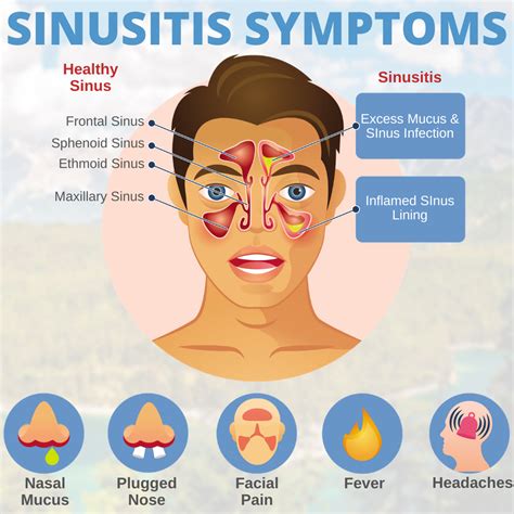 80 Best Of What Are The Symptoms Of Ethmoid Sinusitis Fulton