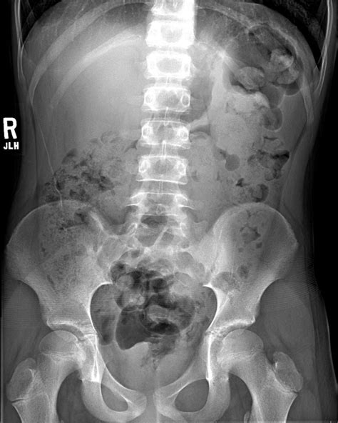 Pediatric Surgery Anorectal Malformation