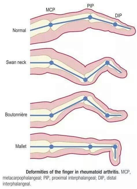 Rheumatoid Arthritis Swan Neck Deformity Vs Boutonniere Deformity