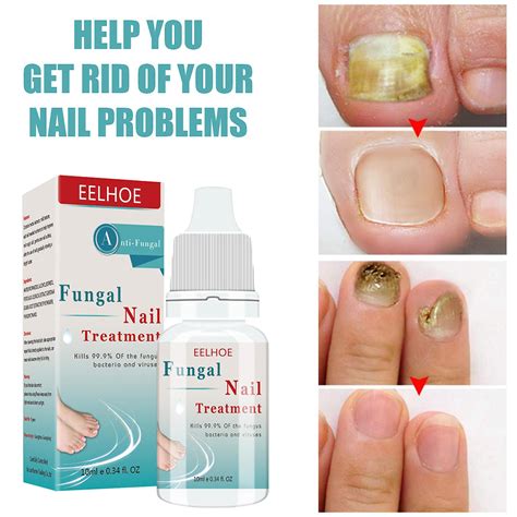 Fungal Nail Treatment Serum Onychomycosis Paronychia Anti Fungal Nail