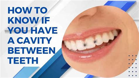 How To Know If You Have A Cavity Between Teeth A Comprehensive Guide