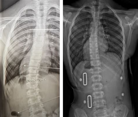 Scoliosis X Ray Before And After