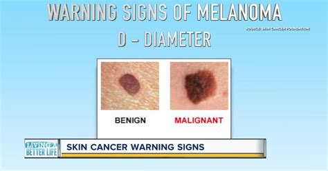 Can You Spot Skin Cancer Keep An Eye Out For These Warning Signs