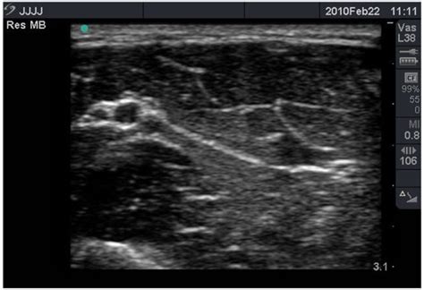 Ultrasound Guided Local Anaesthetic Blocks Of The Forearm Wfsa