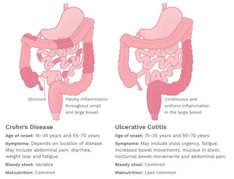 Overview Of Crohns Disease Crohns And Colitis Foundation